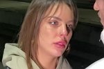 Алёна Опенченко пострадала от рук косметолога