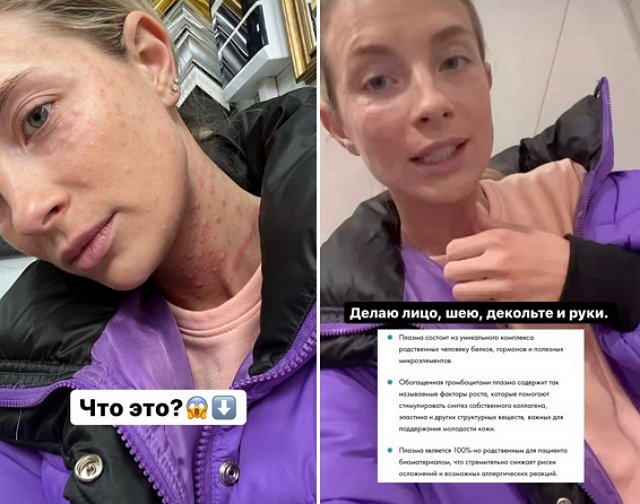Алёна Водонаева и Кристина Черкасова напугали подписчиков своим внешним видом