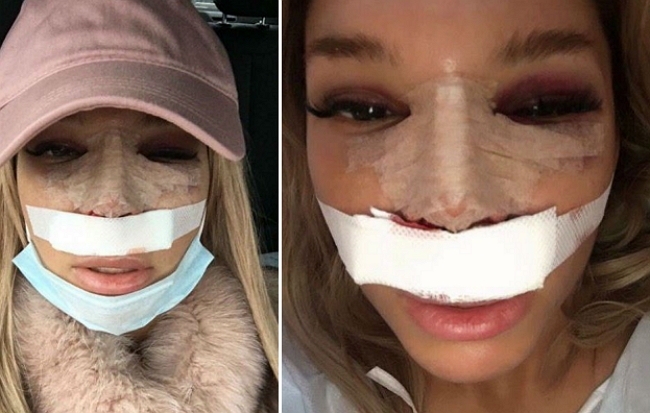 «СтарХит»: Катя Колисниченко вновь легла под нож «СтарХит»: Катя Колисниченко вновь легла под нож