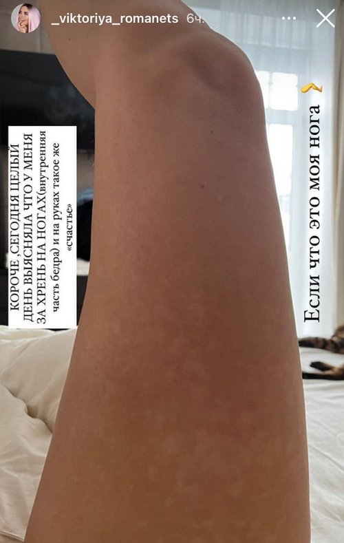 Виктория Романец: Это не лишай и не грибок Виктория Романец: Это не лишай и не грибок