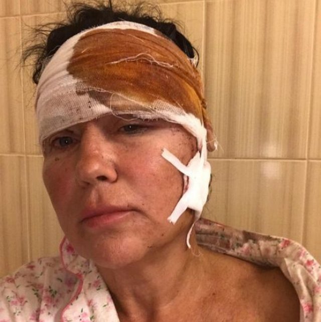 Татьяна Африкантова: У меня срезало кожу до скальпеля Татьяна Африкантова: У меня срезало кожу до скальпеля