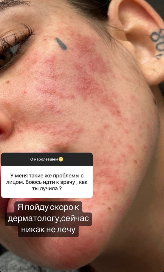 Алёна Опенченко: Скоро к дерматологу...