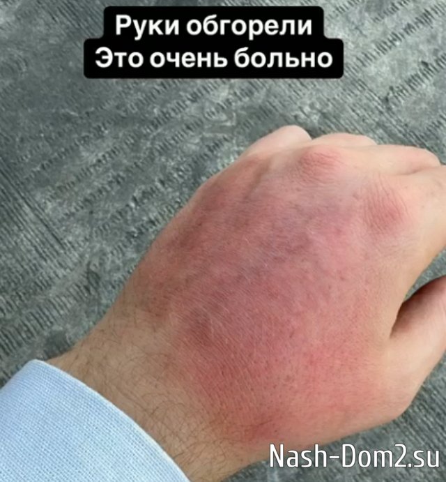 Яббаров возвращается на Дом-2 с травмой руки и хорошими новостями Яббаров возвращается на Дом-2 с травмой руки и хорошими новостями